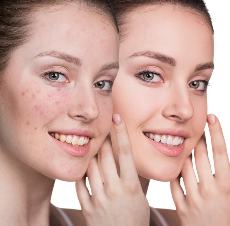 Acne treatment facial